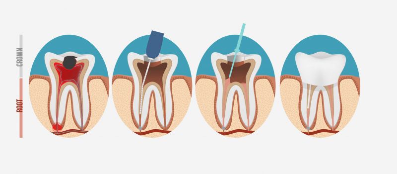 A diagram of a root canal.