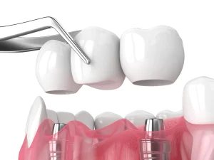 Restorative crowns bridges Guelph