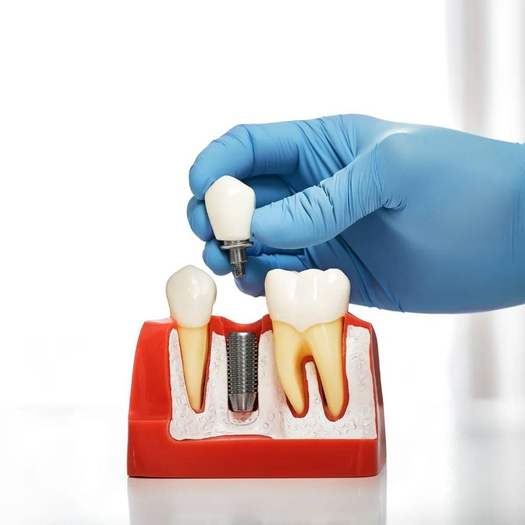 Implant Dentistry in Guelph, ON
