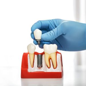 Implant Dentistry in Guelph, ON