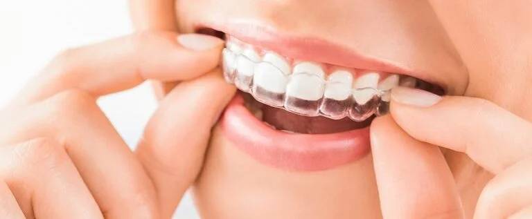 Invisalign in Guelph ON